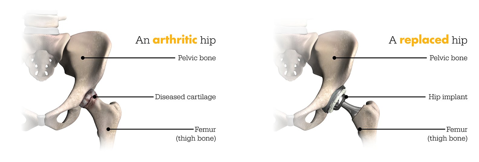 Robotic vs Traditional Hip Replacement Surgery